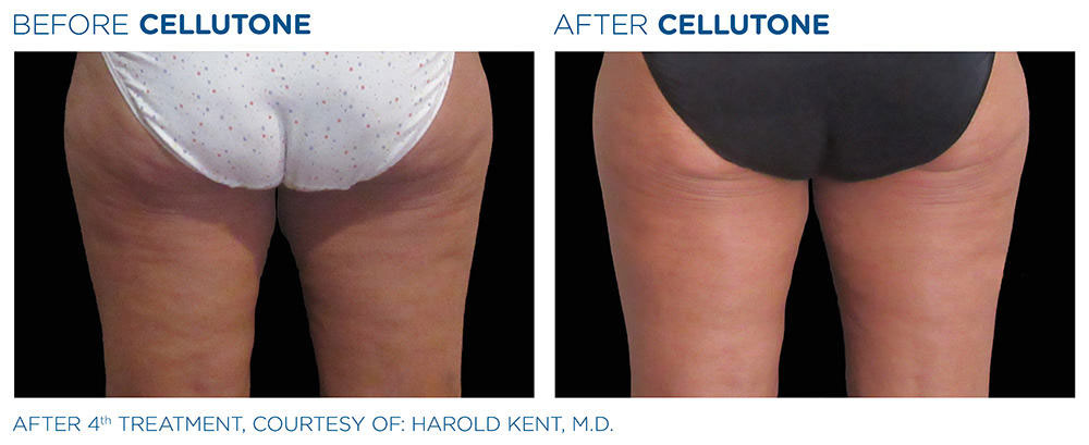 CELLUTONE Before & After | CELLUTONE | Seabreeze Medical PA