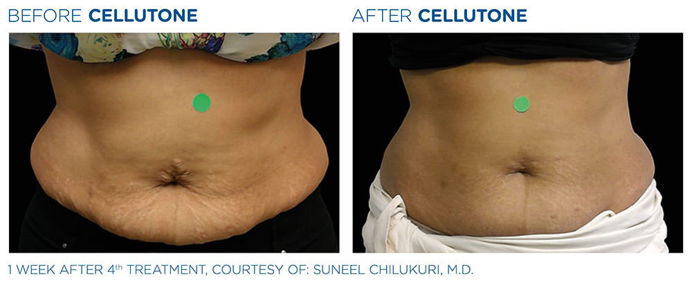 CELLUTONE Before & After | CELLUTONE | Seabreeze Medical PA