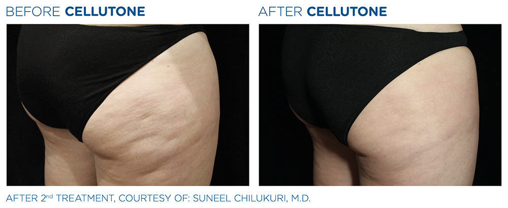CELLUTONE Before & After | CELLUTONE | Seabreeze Medical PA